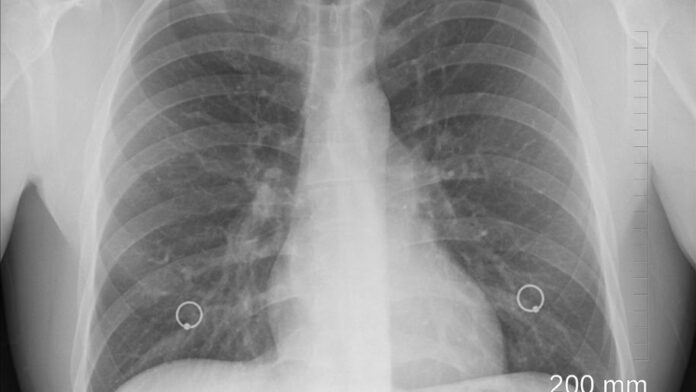 The Crucial Link Between Vitamin K Deficiency and Lung Health
