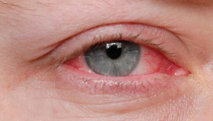 Pink Eye Outbreak in Punjab